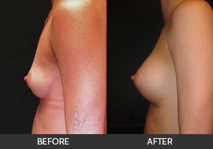 Breast Augmentation Gallery