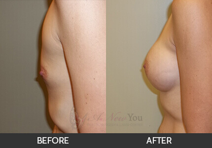 Breast Augmentation Gallery