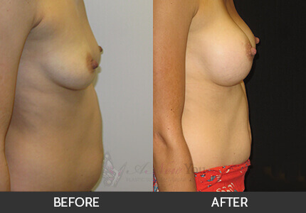 Breast Augmentation Gallery