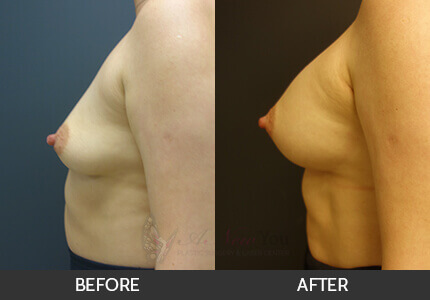 Breast Augmentation Gallery