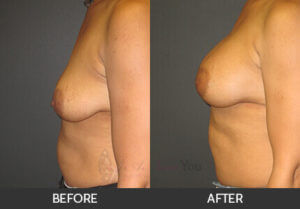 Breast Augmentation Before & After - Chicago, IL