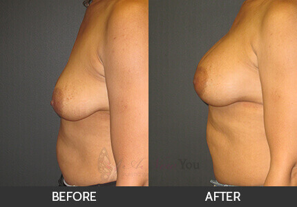 Breast Augmentation Gallery