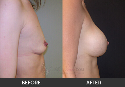 Breast Augmentation Gallery