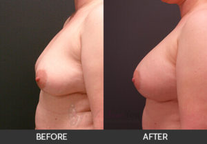 breast-augmentation-35a-thumbs