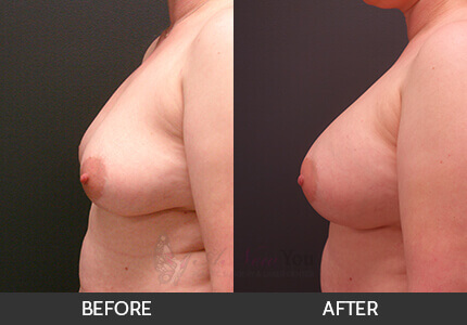 Breast Augmentation Gallery