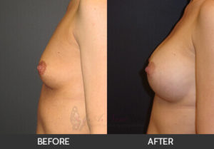 breast-augmentation-36a-thumbs