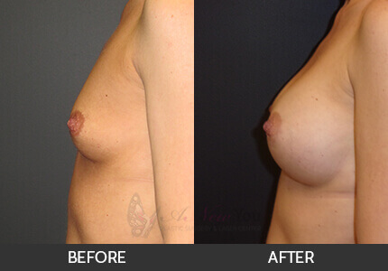 Breast Augmentation Gallery