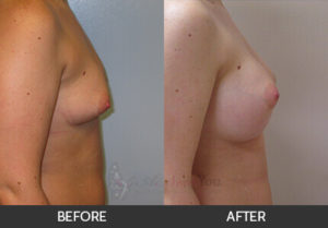 breast-augmentation-37a-thumbs