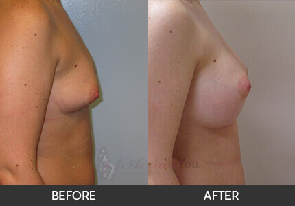 Breast Augmentation Gallery