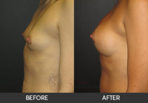 breast-augmentation-38a-thumbs