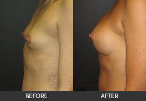 breast-augmentation-38a-thumbs