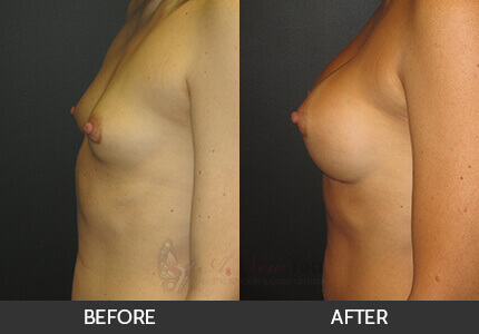 Breast Augmentation Gallery