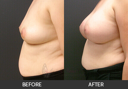 Breast Augmentation Gallery