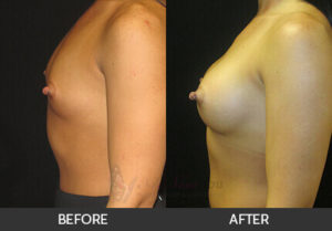 breast-augmentation-40a-thumbs