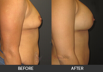 Breast Augmentation Gallery