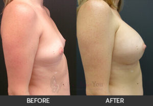 breast-augmentation-42a-thumbs