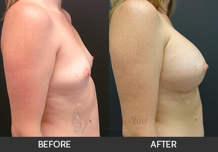 Breast Augmentation Gallery