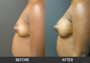 Breast Augmentation Before and After, Chicago, IL