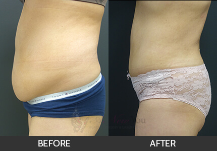 Tummy Tuck Gallery