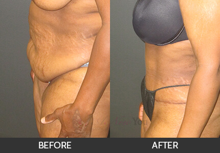 Tummy Tuck Gallery