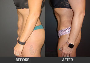 Tummy Tuck Before and After, Chicago, IL