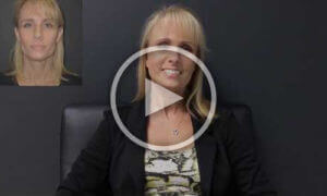 Facelift Patient Testimonial Video