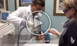 Facial Rejuvenation<br />Erbium Laser Video