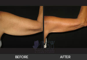 Arm Lift (Brachioplasty) Before and After - Chicago, IL