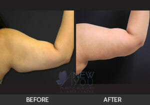 Arm Lift (Brachioplasty) Before and After - Chicago, IL