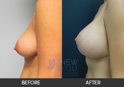 Breast Augmentation Gallery