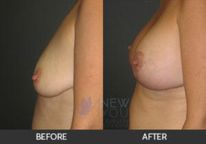 Breast Augmentation Before and After, Chicago, IL