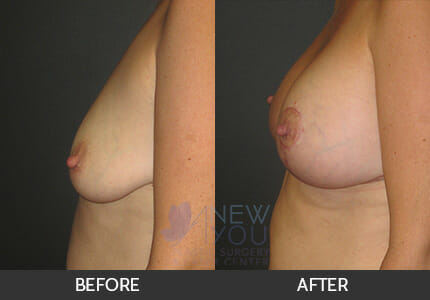 Breast Augmentation with Lift (Mastopexy) Gallery