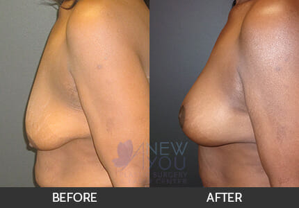 Breast Augmentation Gallery