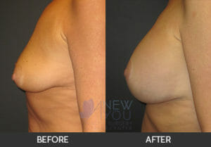 Breast Augmentation Before and After, Chicago, IL