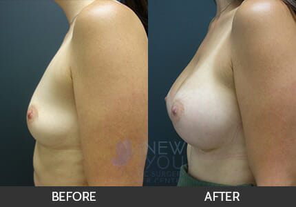 Breast Augmentation Gallery