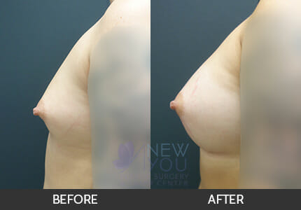 Breast Augmentation Gallery