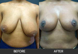 Breast Lift Before and After, Chicago, IL