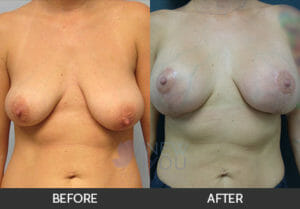 Breast Lift with Augmentation Before and After, Chicago, IL