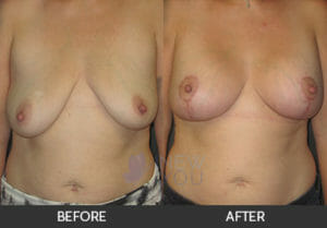 Breast Lift with Augmentation Before and After, Chicago, IL