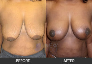 Breast Lift with Augmentation Before and After, Chicago, IL