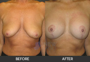 Breast Lift with Augmentation Before and After, Chicago, IL