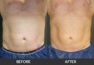 CoolSculpting® Before and After, Chicago, IL