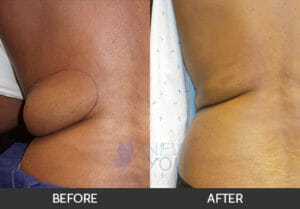 CoolSculpting® Before and After, Chicago, IL
