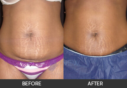 CoolSculpting® Gallery