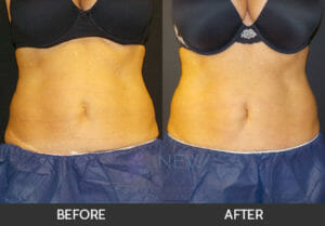CoolSculpting® Before and After, Chicago, IL
