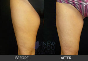 CoolSculpting® Before and After, Chicago, IL