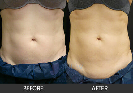 CoolSculpting® Gallery