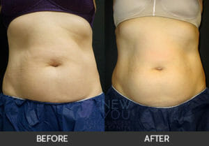 CoolSculpting® Before and After, Chicago, IL