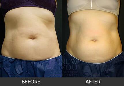 CoolSculpting® Gallery