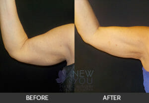 CoolSculpting® Before and After, Chicago, IL